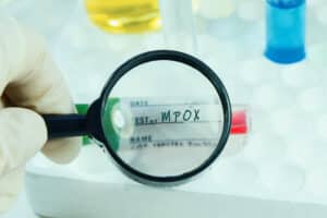 mpox variole