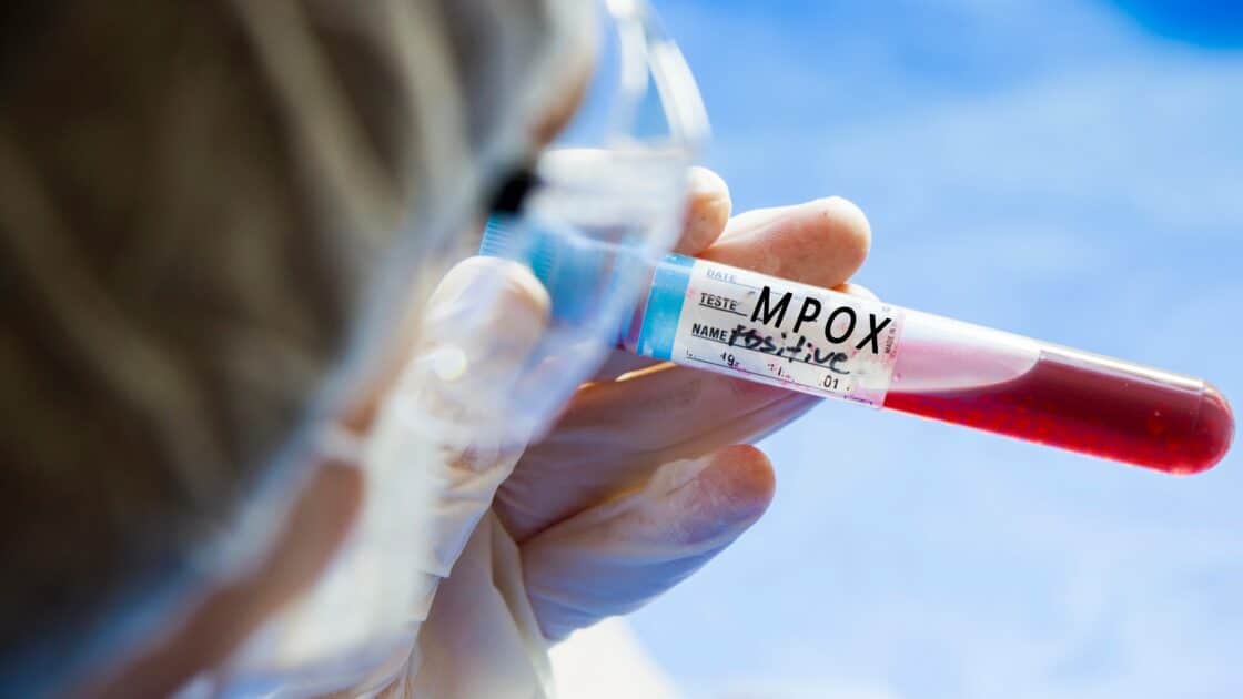 mpox variole